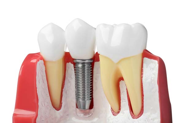 Reasons To Choose Implants For Tooth Restoration